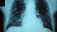 Pneumonia